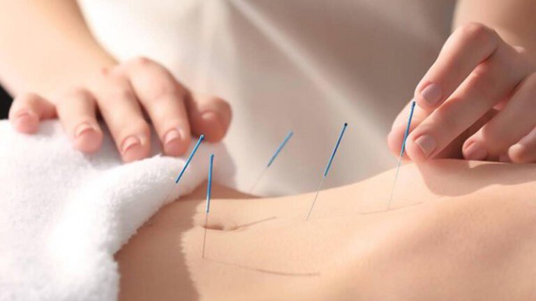 Acupuncture Vancouver BC